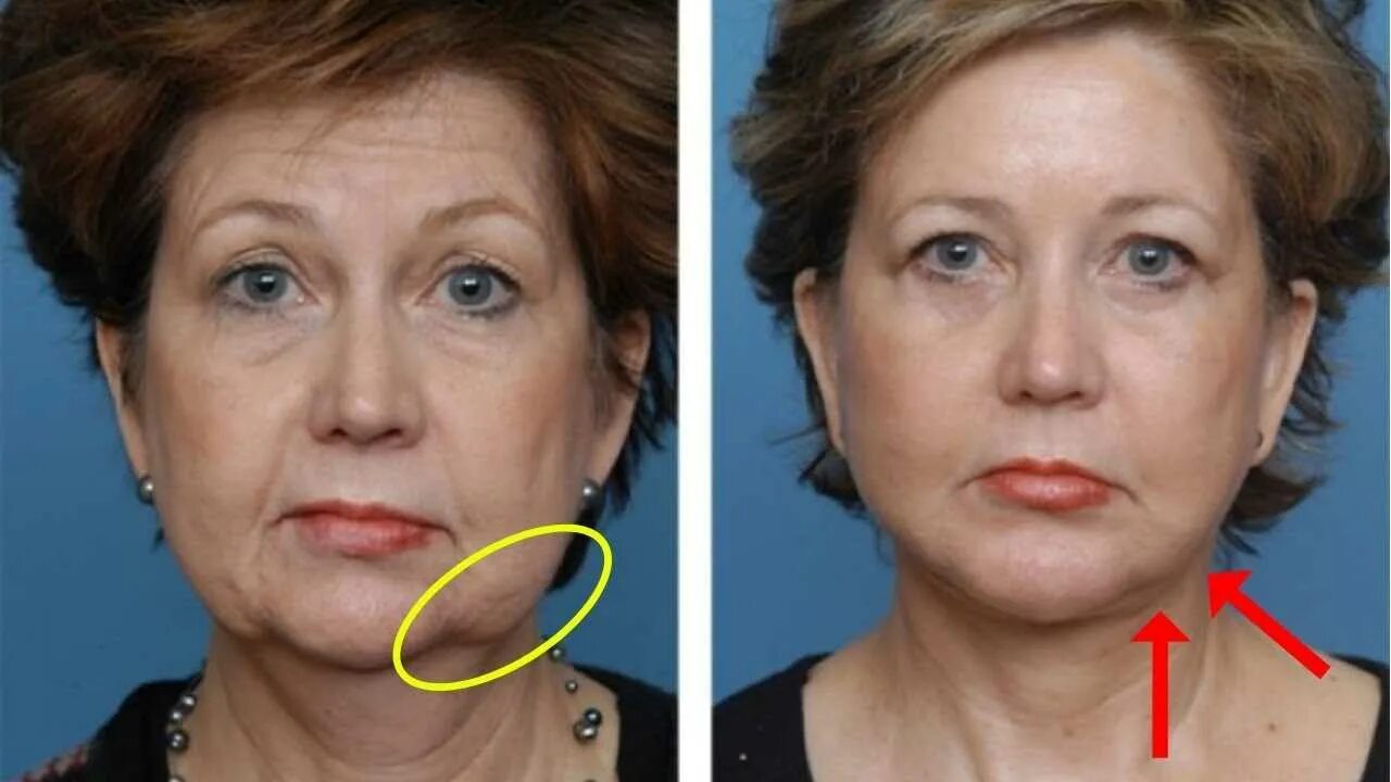 Брылья это. Брыли. Брылья. Брылья это. Птоз и брыли на лице.