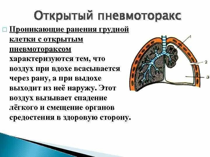 При вдохе давление в легких падает. Открытый пневмоторакс. Травмы грудной клетки презентация. Парадоксальное дыхание при открытом пневмотораксе. Открытый пневмоторакс механизм.