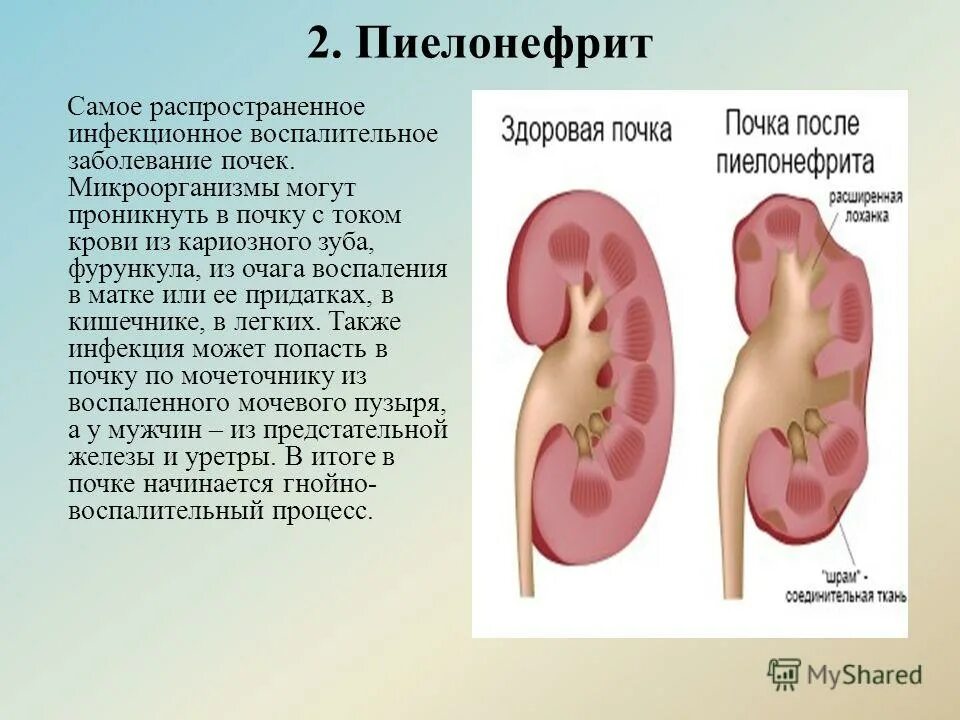 Как лечить воспаление почек