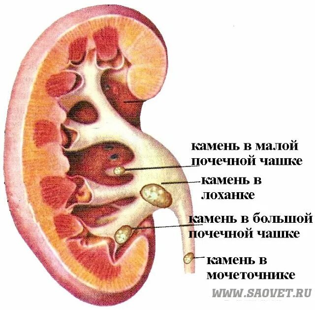 Образования в почке у мужчин