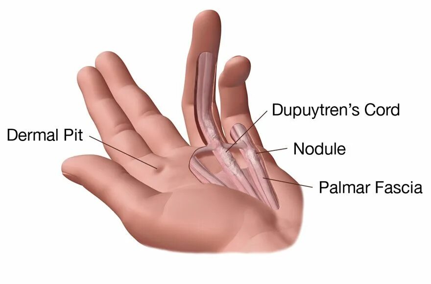 Почему тянут пальцы. Ладонный фиброматоз (контрактура Дюпюитрена). Контрактура сухожилий кисти. Контрактура Дюпюитрена что такое сустава. Контрактура ладонного апоневроза.