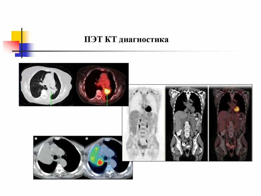 ПЭТ кт снимки. ПЭТ кт диагнозы. Кт, ПЭТ И ПЭТ/кт. ПЭТ кт с контрастом. Пэт кт или кт что лучше