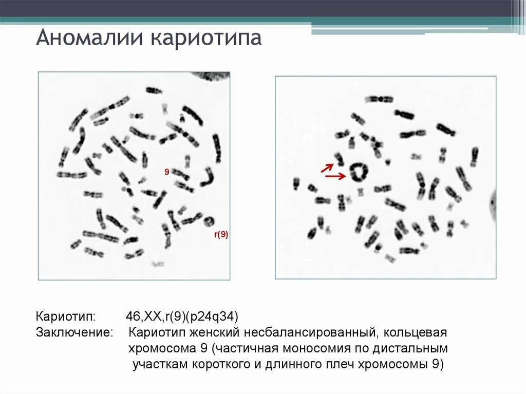 Аномалии кариотипа. Альбинизм кариотип. Кольцевая хромосома в кариотипе. Аномальный кариотип расшифровка. Кольцевая 4 хромосома