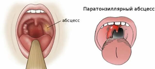 Люголь миндалины. Флегмонозный тонзиллит. Воспаленные небные миндалины. Небные миндалины тонзиллит.