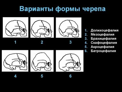 Черепные аномалии