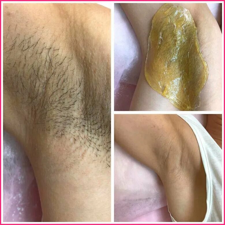 депиляция ног до и после. какие волосы депиляции. депиляция до и после фото. какие волосы депиляции. шугаринг зоны глубокого бикини.