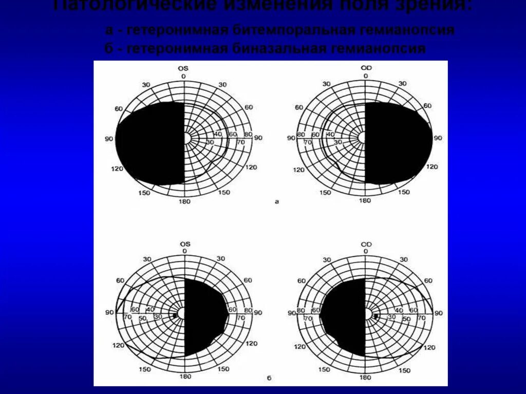 Гомонимная гемианопсия поражение. Левосторонняя гемианопсия поля зрения. Поражение зрительного нерва на разных уровнях. Гомонимная гемианопсия поражение. Гетеронимная битемпоральная гемианопсия.