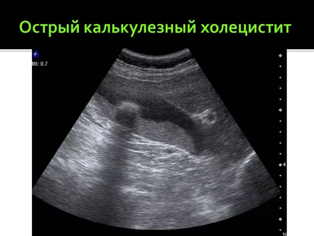 Узи жкб. Острый калькулезный холецистит. УЗИ желчного пузыря острый холецистит. Острый калькулезный холецистит на УЗИ. УЗИ желчного пузыря калькулезный холецистит.