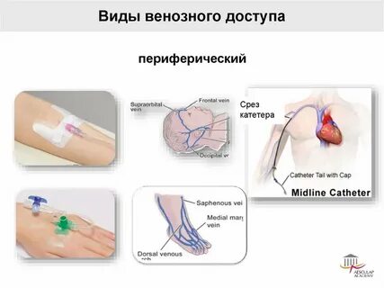 Постановка венозного катетера