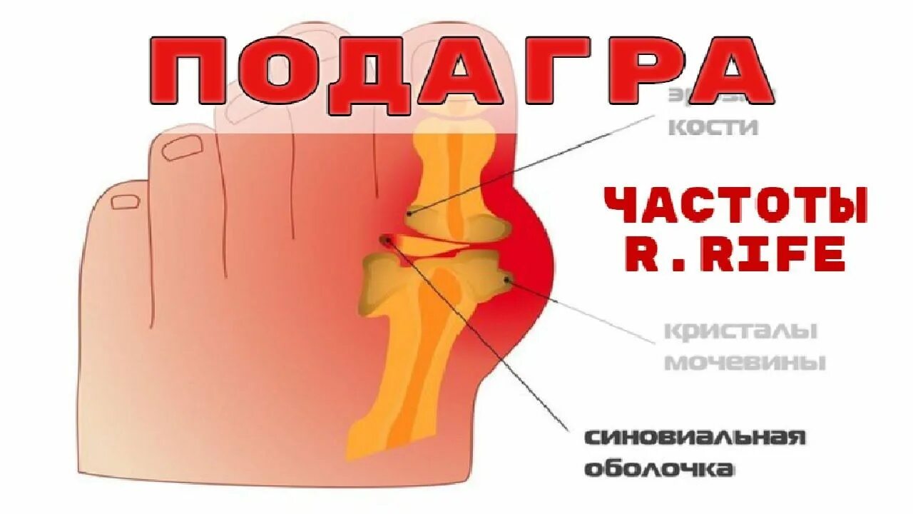 Исцеляющие частоты доктора Шмидта. Квантовое исцеление костей. Квантовое исцеление костей и суставов. Магическая подагра. Матрица мощное исцеление костей и мышц