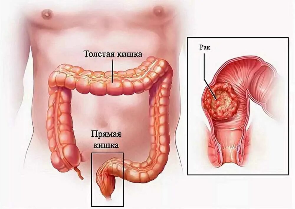 Раковая опухоль толстой кишки. Опухоли ободочной и прямой кишки. Непроходимость толстой кишки. Злокачественное новообразование ободочной кишки. Удлинена сигмовидной