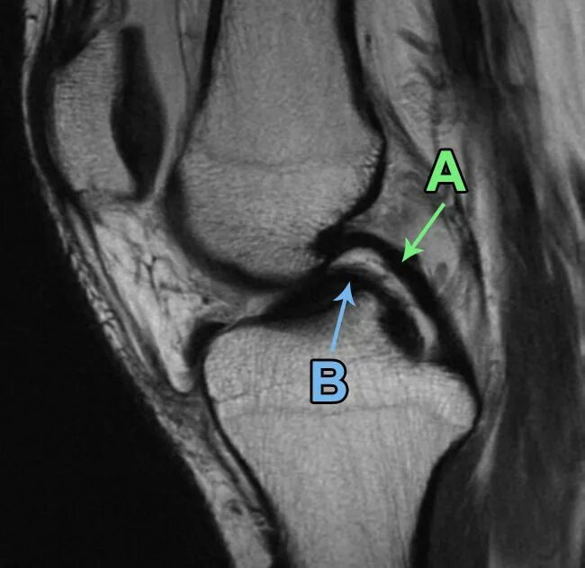 Разрыв мениска мрт. Мрт мениска коленного сустава. Разрыв ручки лейки мениска. Мениск по типу ручки лейки мрт. Повреждение мениска ручка лейки мрт.