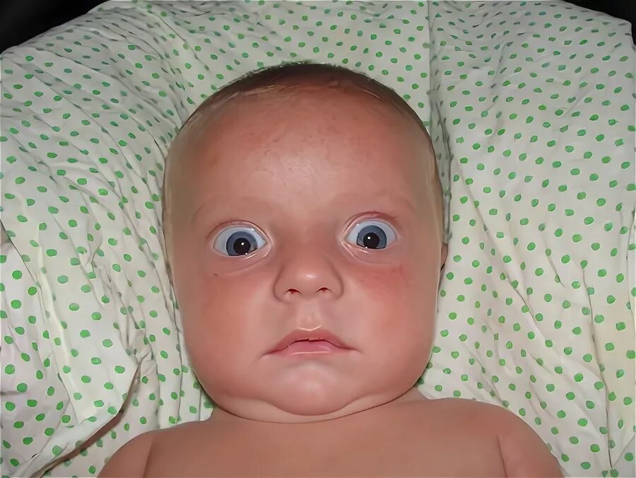 Симптом Грефе у грудничков. Глаза новорожденного ребенка. Слихвой