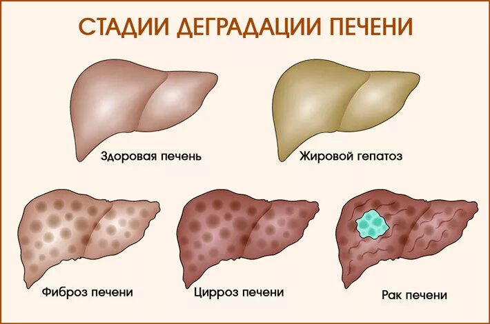 Печень 1 стадия