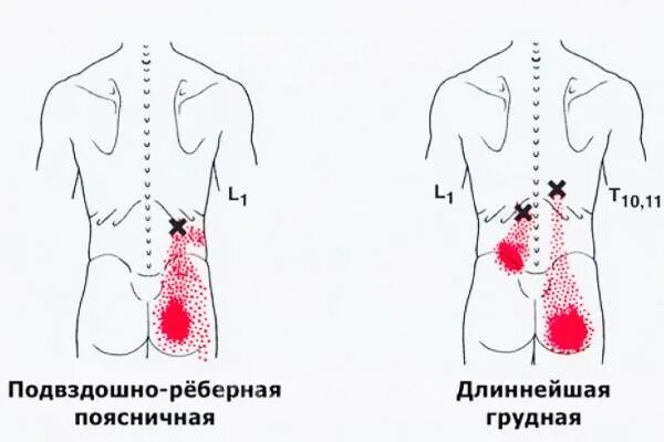 Триггерные точки поясницы. Миофасциальный синдром триггерные точки спины. Триггерные точки и отраженная боль карта. Подвздошно реберная мышца триггерные точки. Миофасциальный болевой синдром триггерные точки.