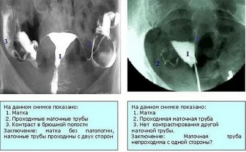 Можно вылечить непроходимость труб