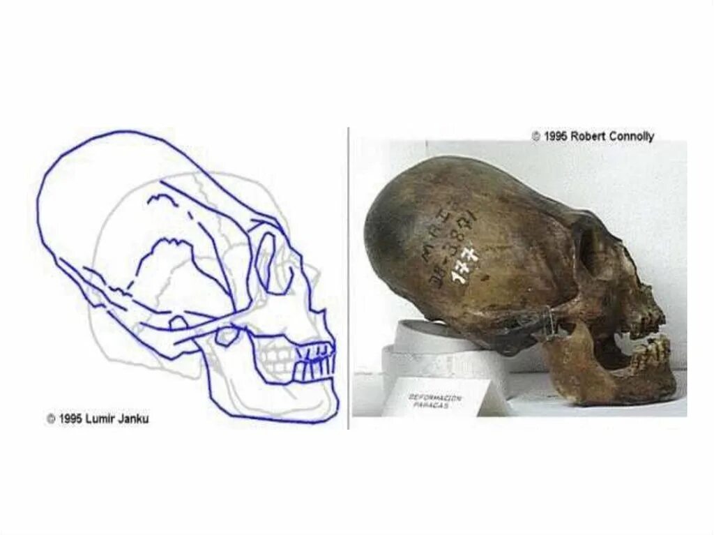 Черепная аномалия. Вытянутые черепа Перу Паракас. Аномалии костей черепа. Культура Паракас черепа.