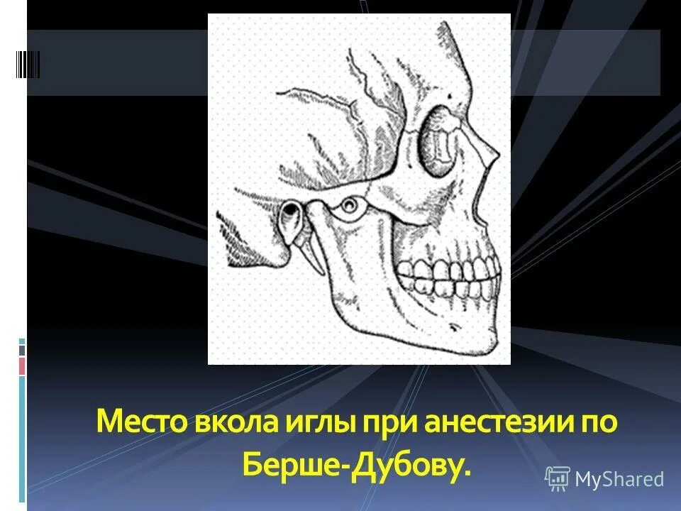 стволовая анестезия по берше-дубову-уварову, вайсблату. стволовая анестезия по берше-дубову-уварову. блокада нижнечелюстного нерва по берше дубову. анестезия по берше дубову уварову. мандибулярная анестезия по берше дубову.