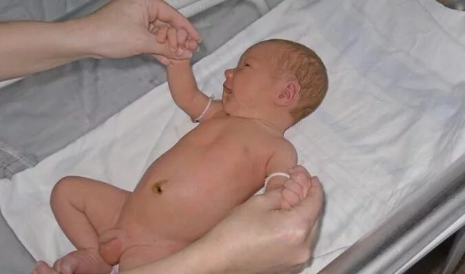 Дети с открытой головкой. Половые органы новорожденных мальчиков. Патология половых органов у новорожденных мальчиков.