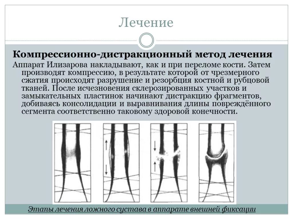 Дистракционно-компрессионный остеосинтез. Компрессионно-дистракционный аппарат Илизарова. Компрессионно-дистракционный остеосинтез аппараты. Компрессионно-дистракционный метод лечения переломов костей.