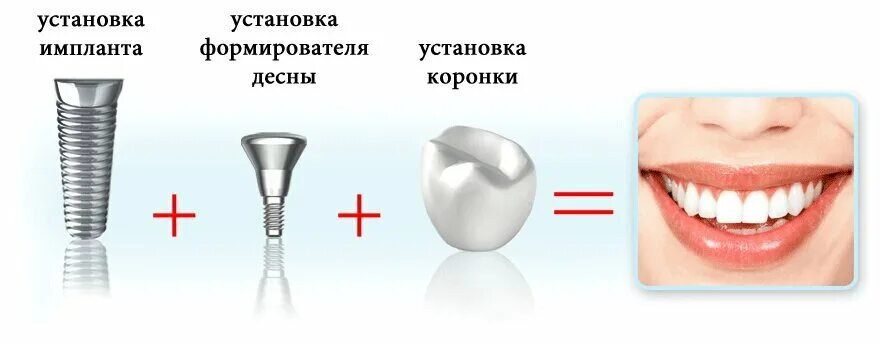 После установки формирователей. Имплант и формирователь десны схема. коронка абатмент формирователь. формирователь десны для импланта. схема установки стоматологических имплантов.