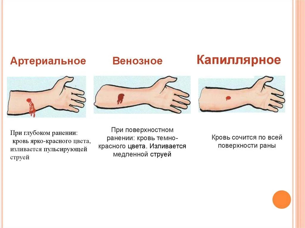 Венозная кровь наблюдается в. Артериальное кровотечение схема. Артериальное венозное и капиллярное кровотечение. Венозная и артериальная кровь различия. Различие артериального и венозного кровотечения.