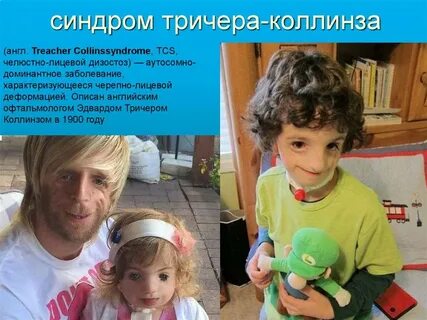 Барбер сей синдром
