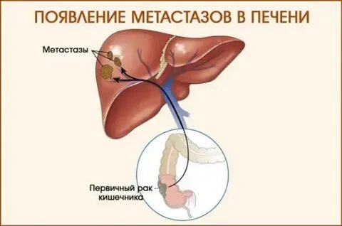4 стадия без метастаз