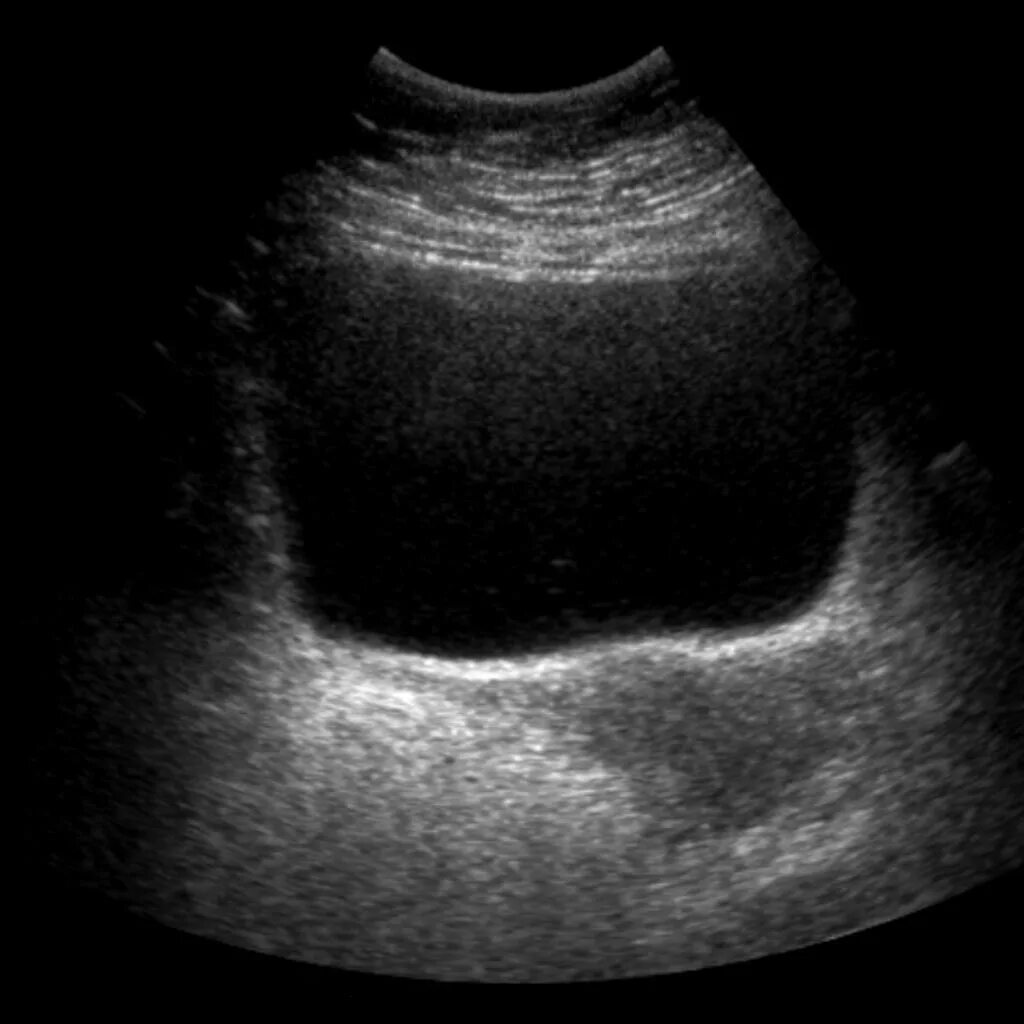 Узи в полный рост. Сонография мочевого пузыря. Тампонада мочевого пузыря на УЗИ. Ультрасонография мочевого пузыря. Ультразвуковое исследование (УЗИ) мочевого пузыря.