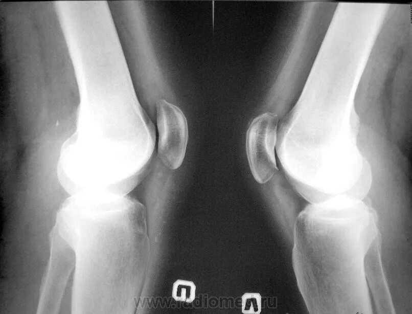 Лигаментоз крестообразных связок коленных. Лигаментоз коленного сустава рентген. Фабелла коленного сустава рентген. Лигаментоз надколенника. Тендиноз коленного сустава рентген.