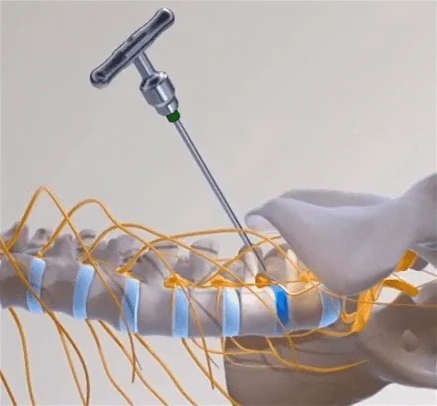 Блокада грыжи цена. Блокада при межпозвоночной грыже. Блокада позвоночника при грыже. Блокада межпозвоночной грыжи поясничного отдела. Блокада при грыже поясничного отдела.