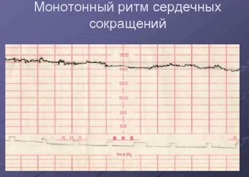 Сердцебиение плода девочка. Монотонный ритм на КТГ. Сердцебиение плода по неделям. ЧСС норма по неделям беременности таблица. Монотонное сердцебиение.