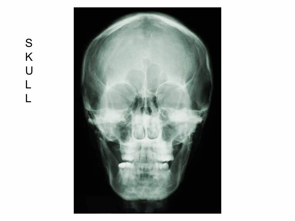 Трещина в голове. Перелом теменной кости черепа рентген. Перелом теменной кости рентген. Рентген затылочной кости черепа. Многооскольчатый перелом лобной кости.