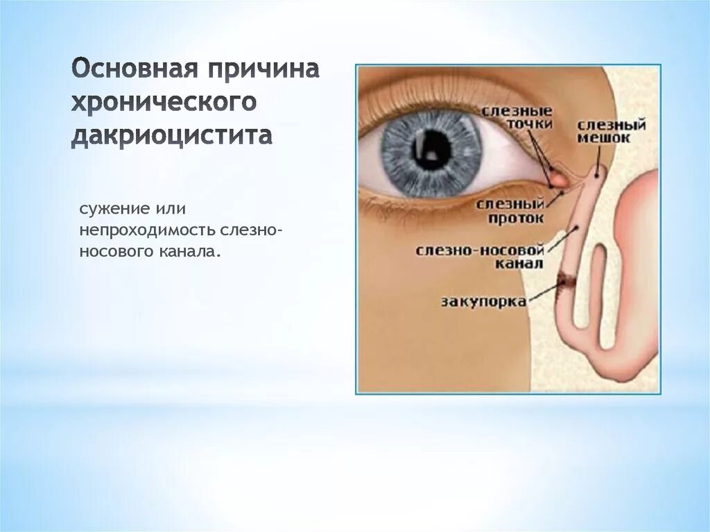 Слезный канал открывается. Признак острого дакриоцистита. Воспаление слезного канала дакриоцистит. Хронический Гнойный дакриоцистит.