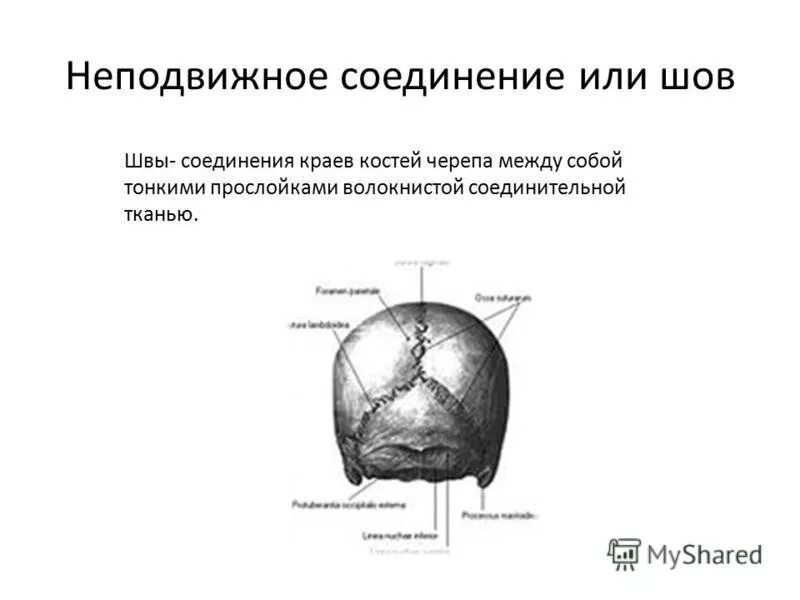 Шов между теменными костями. Соединения костей черепа анатомия швы. Фиброзные соединения костей черепа. Шов это неподвижное соединение костей. Неподвижное соединение костей черепа.