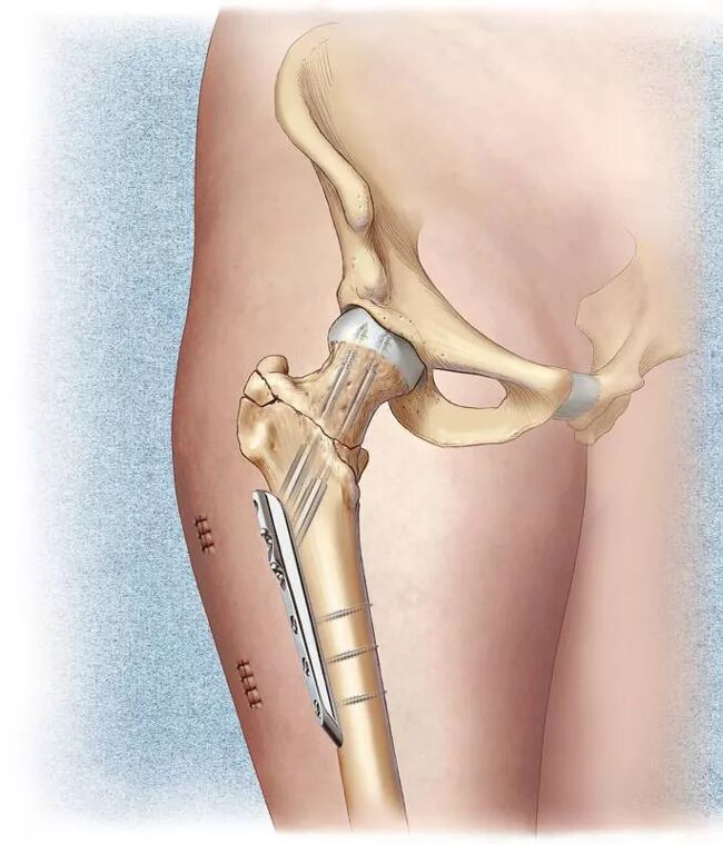 Чрезвертельный перелом шейки бедра. Интрамедуллярный остеосинтез тазобедренного сустава. Перелом шейки бедренной кости. Перелом шейки бедра эндопротезирование тазобедренного сустава.