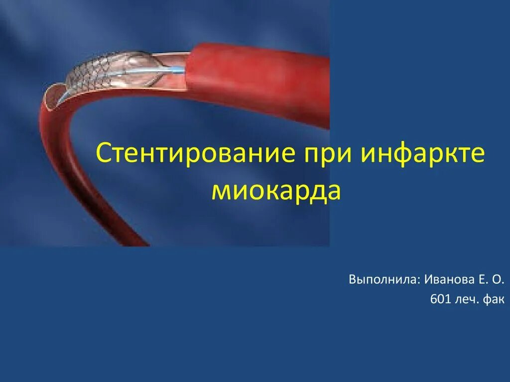 Инфаркт миокарда стентирование. Стентирование при инфаркте. Стент при инфаркте миокарда что это такое. Инфаркт миокарда операция стент. Стенты отзывы