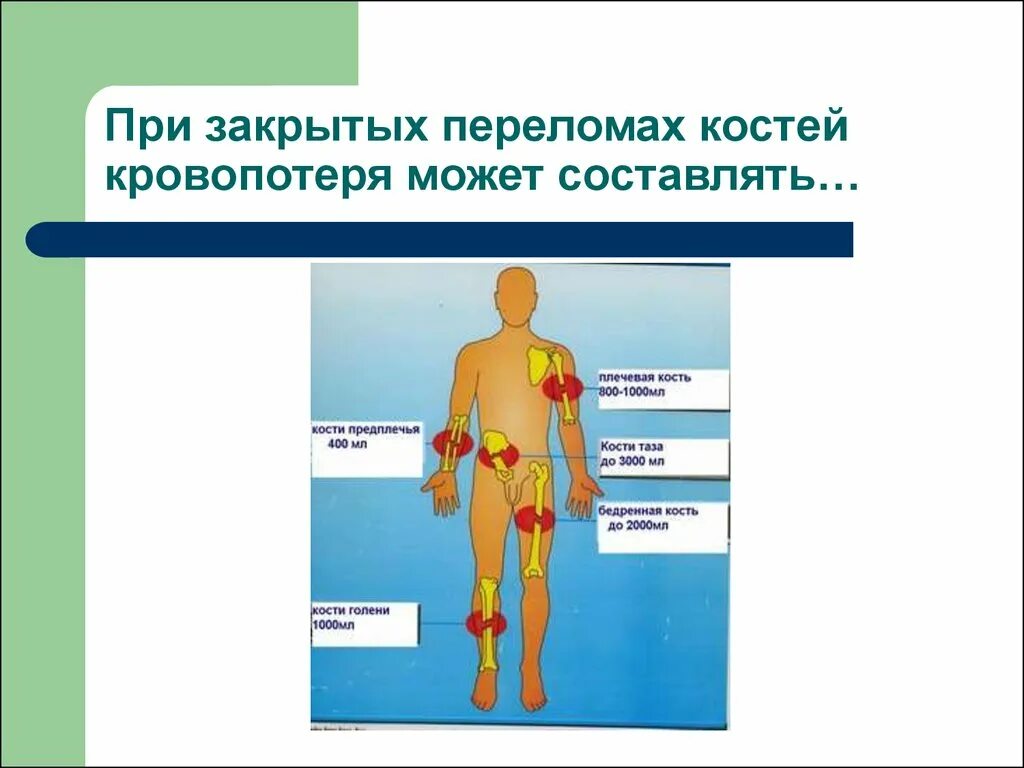 Кровопотери при переломах. Травмы опорно-двигательного аппарата. травмы опорно двигательной системы человека. травмы опорно-двигательного аппарата симптомы. кровопотеря при переломах костей.