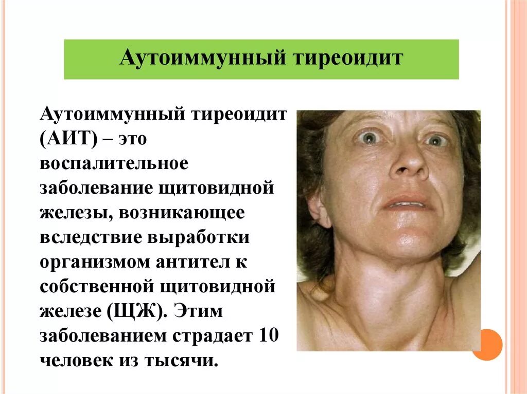 Хронический аутоиммунный тиреоидит гипотиреоз щитовидной железы. Хронический аутоиммунный тиреоидит синдромы. Аутоиммунные заболевания щитовидной железы тиреоидит.
