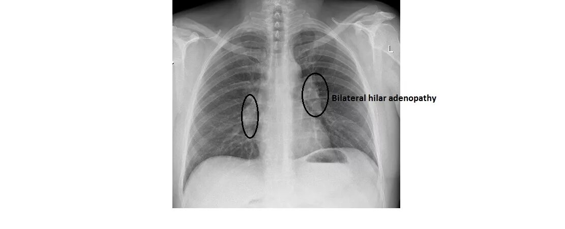Аденопатия. Лимфоузлы средостения рентген. Медиастинально-легочный саркоидоз. Саркоидоз на рентгенограмме. Медиастинальная лимфаденопатия рентген.