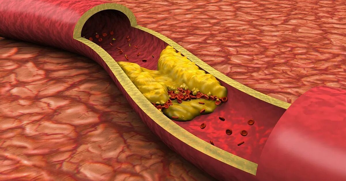 Атеросклероз (закупорка кровеносных сосудов). Холестериновые бляшки в сосудах. Гиперхолестеринемия дислипидемия. Атеросклерозная бляшка. Как очистить сосуды от холестериновых тромбов