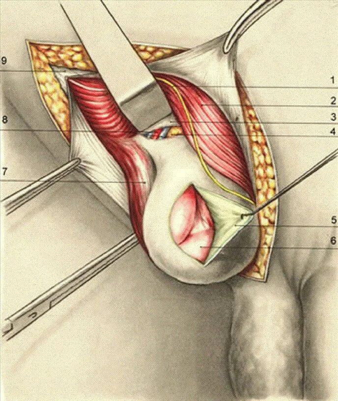 Косая паховая грыжа анатомия. Паховая грыжа и семенной канатик. Топографическая прямая паховая грыжа. Прямая паховая грыжа топография. Яички в брюшную полость