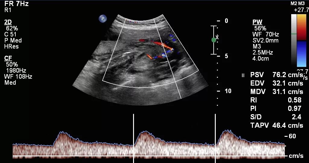 Допплерография ребенку. Допплерография при беременности 3 триместр. Ультразвуковая допплерография маточно-плацентарного кровотока. УЗИ маточных артерий при беременности норма. Допплер УЗИ при беременности нормы.