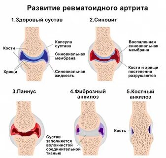Можно греть воспаленный сустав