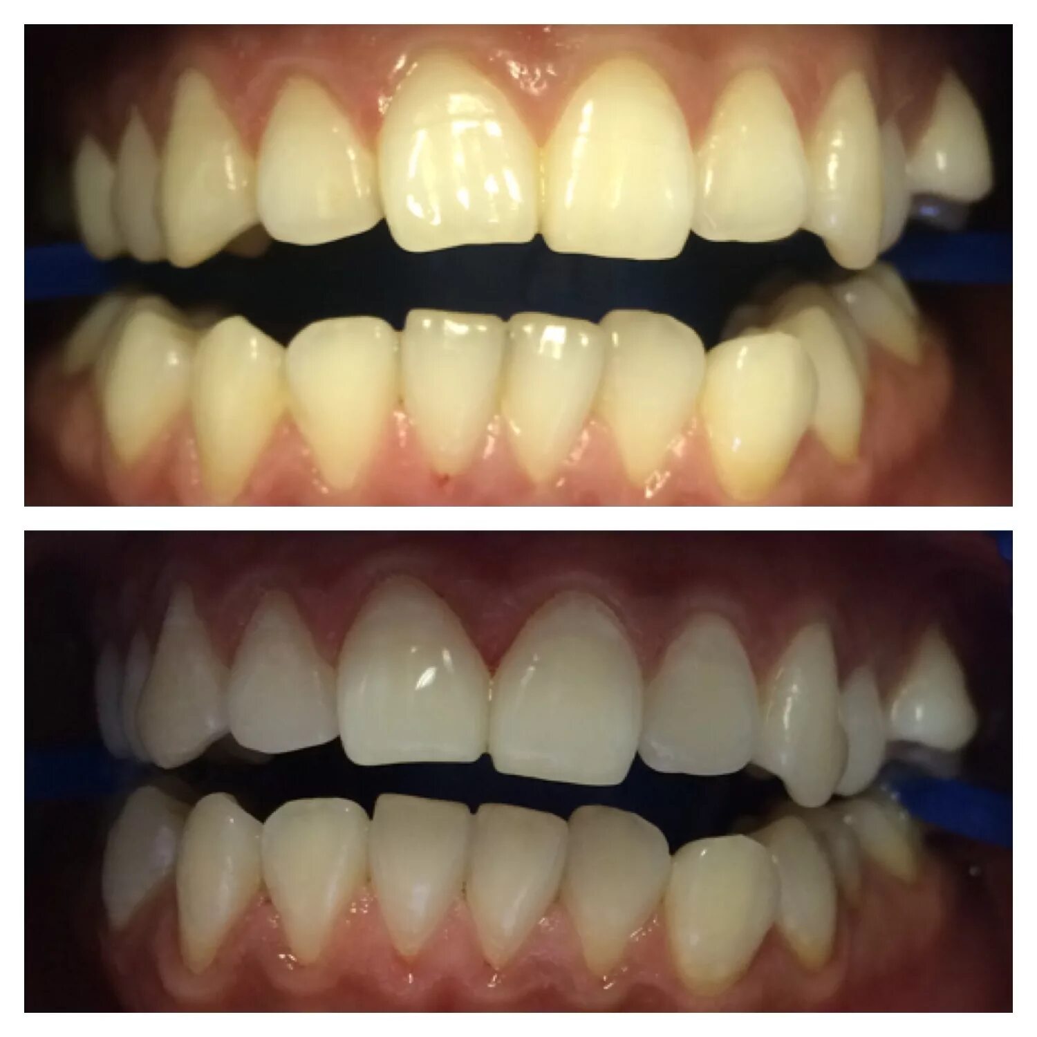 Отбеливание зубов. Отбеливание зубов до и после. Отбеливание витальных зубов. Отбеливание зубов в стоматологии до и после.