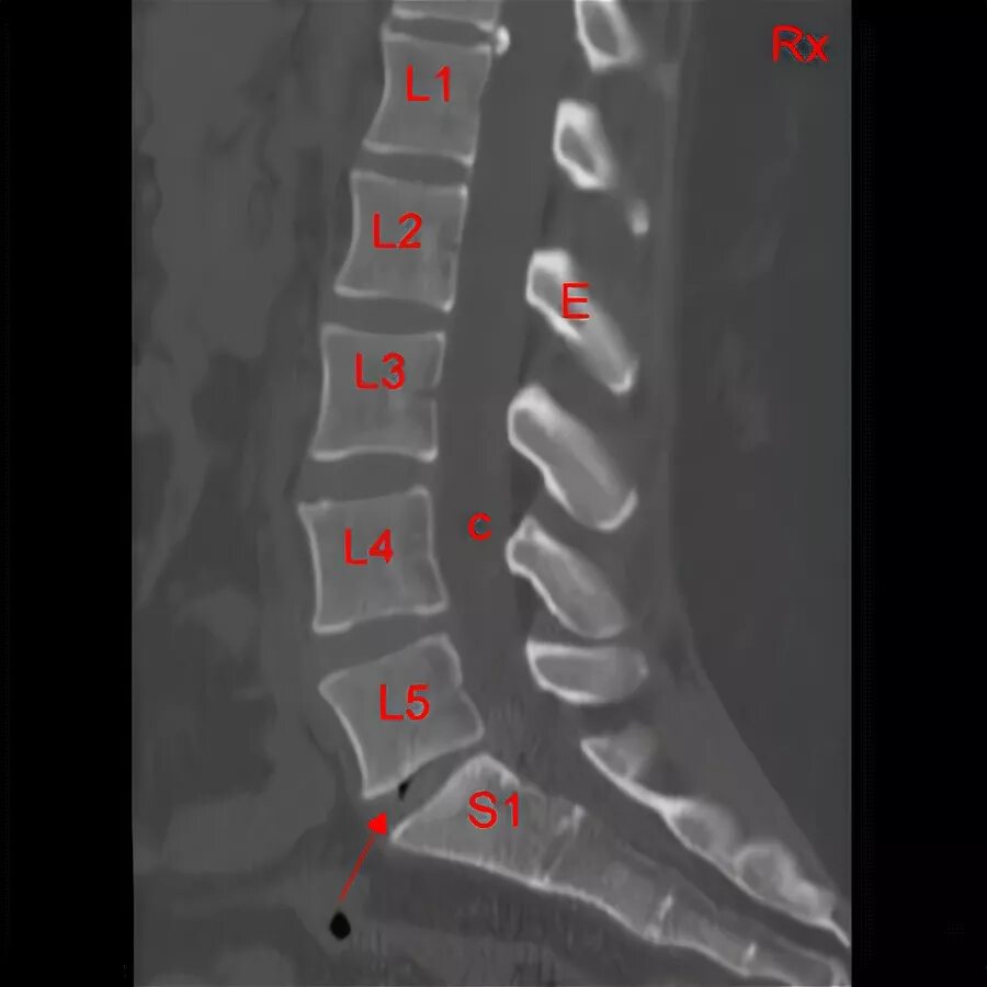 Позвоночник отдел l3 s1. Межпозвонковые диски l2 l3. L3 s1 позвонки. Сегмент l1-l2 позвоночника. Протрузия l3-l4 l4-l5.
