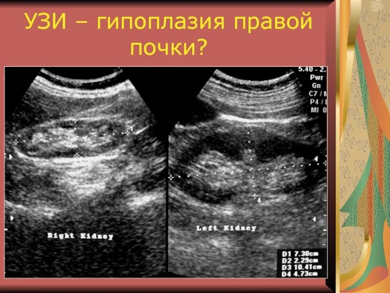 Кальциноз коронарных артерий. Добавочная долька селезенки на узи. Лимфангиома селезенки кт. Роль нарушений механизмов онтогенеза в патологии человека. Гипоплазия селезенки.