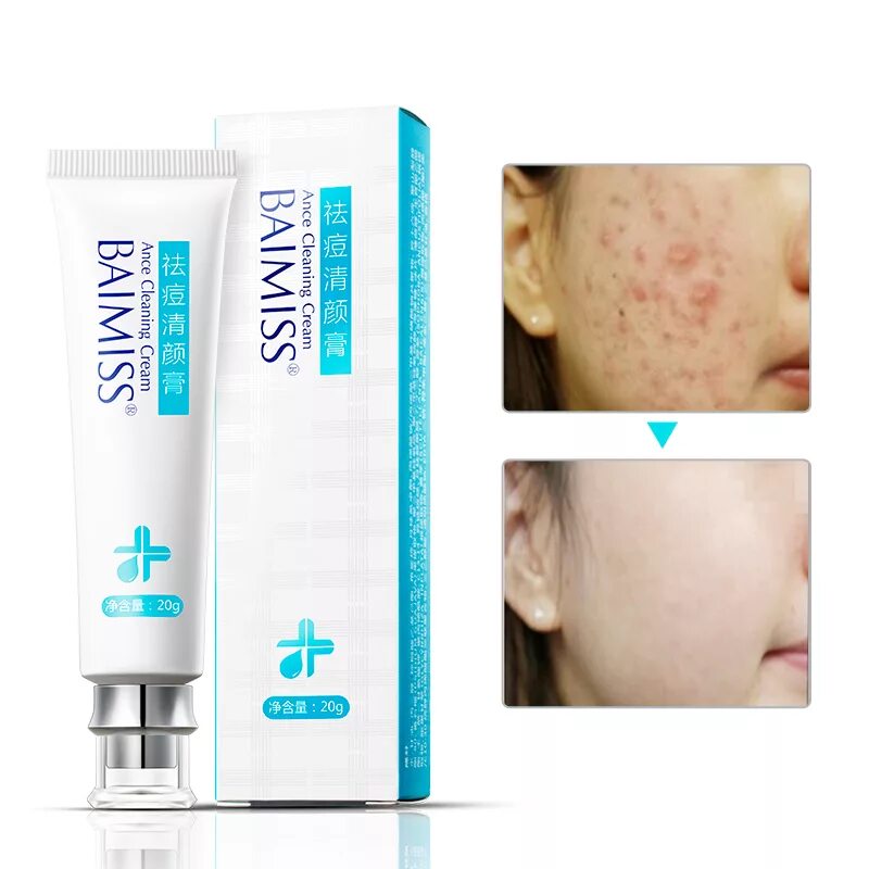 Анти-акне крем Anti-acne Cream. Препараты от акне. Средство от прыщей. Крем убирающий прыщи