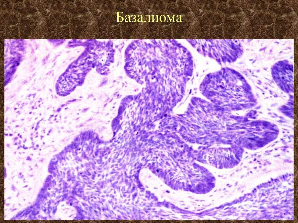 базалиома патанатомия. базалиома патанатомия. Squamous cell carcinoma гистология. базалиома патоморфология. базалиома препарат.