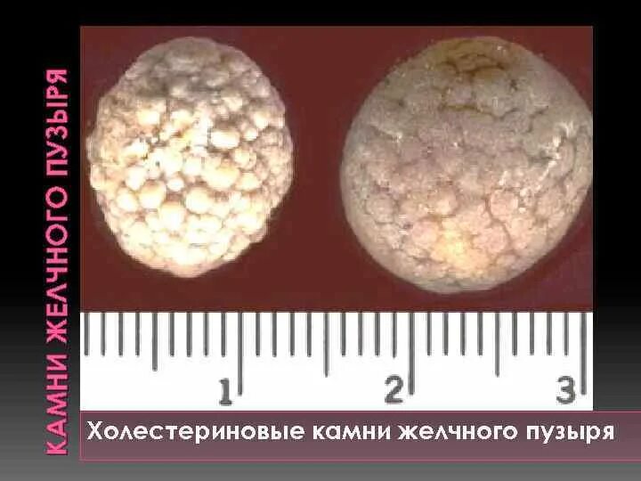 Файл:Gallstones1pl.jpg - Википедия